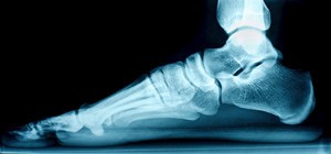 Benefits and Drawbacks of Flat Foot Surgery