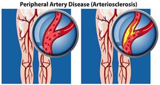 Various Causes for PAD