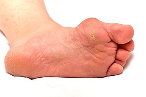 What Are Bunions?