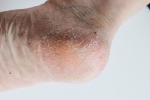 Solutions for Cracked Heels