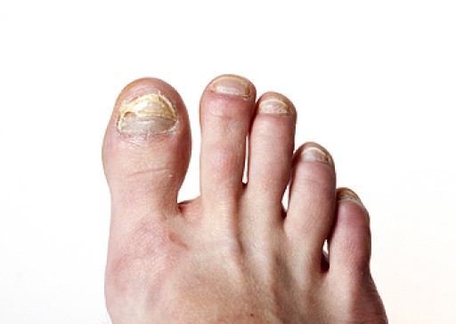 How to Treat Your Toenail Fungus