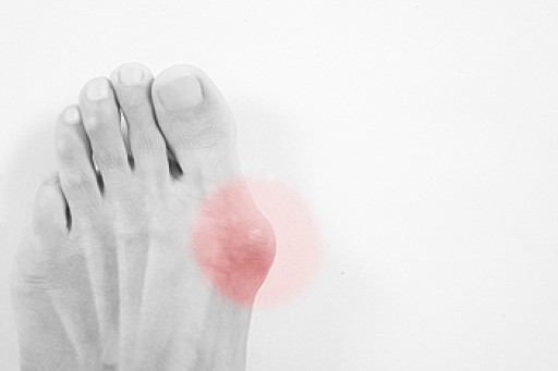 How Does A Bunion Develop?