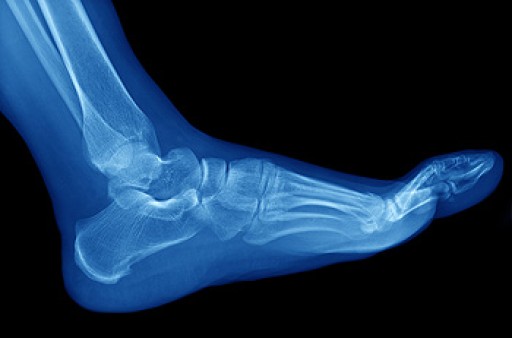 Cuboid Syndrome