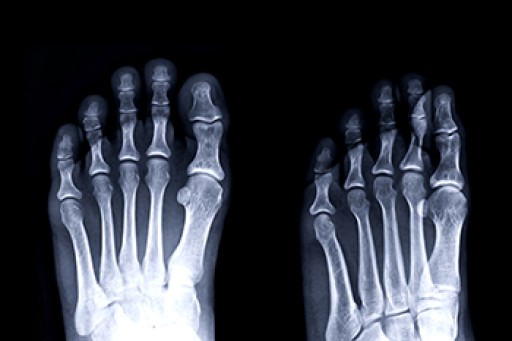 Stress Fractures of the Foot and Ankle