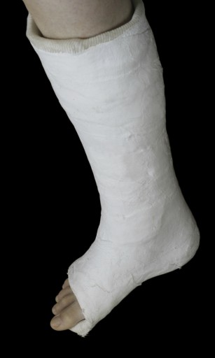 Causes, Symptoms, and Treatment for a Broken Foot