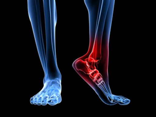 How to Treat Heel Spurs