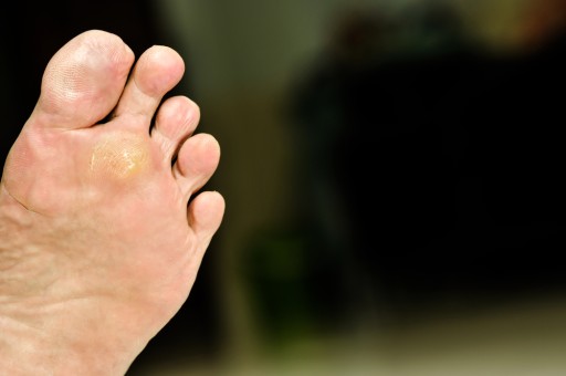 Where Does a Plantar Wart Develop?