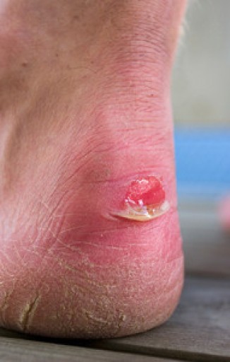 Blisters