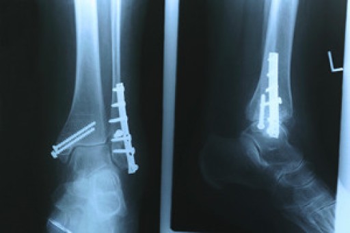Joint Replacement Surgery