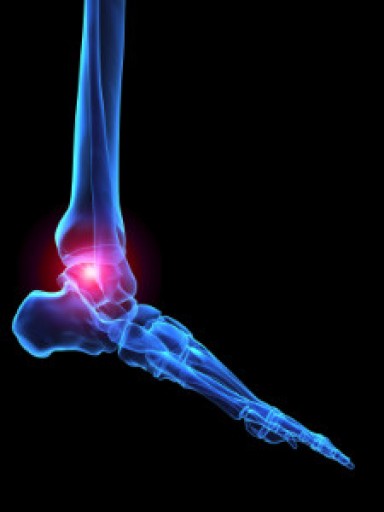 Rheumatoid Arthritis in the Feet