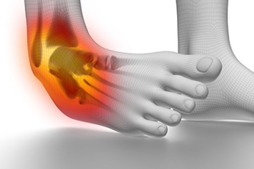 Three Grades of Ankle Sprains