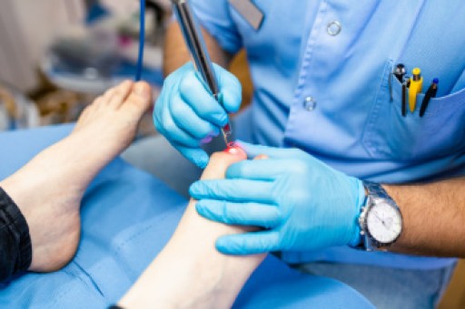 Laser Treatment for Fungal Nails