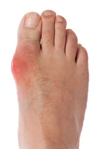 Gout