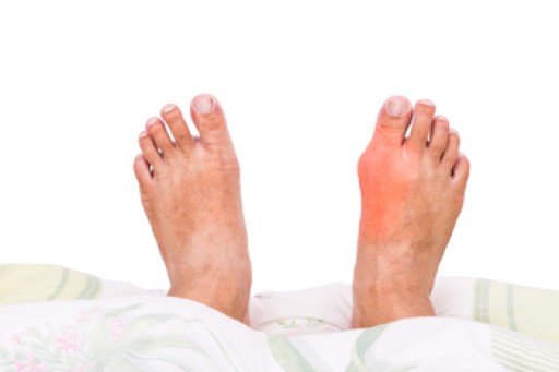 Everything You Need to Know About Gout