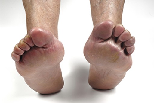 Arthritic Foot Care