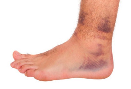 Ankle Sprains