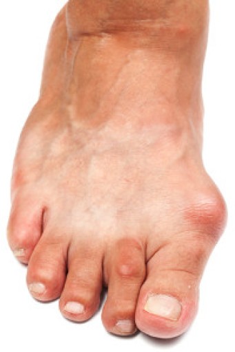 Bunions