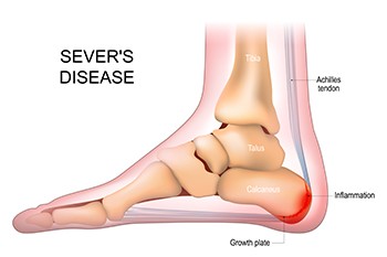 Heel Pain in Active Children May Indicate Sever's Disease