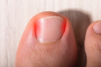 When Toenails Turn Troublesome