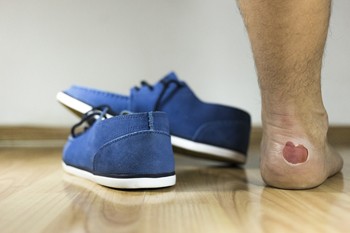 Causes of Blisters on the Feet