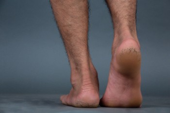 Cracked Heels and Their Common Causes