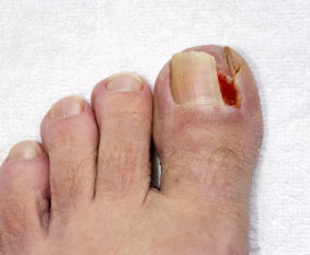 Ingrown Toenails Treatment Foot Doctor North Andover MA 01845