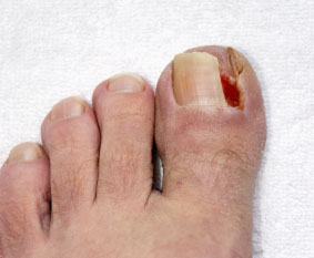 Ingrown Toenails Treatment  Foot Doctor North Andover, MA 01845