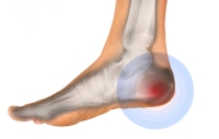 There Are Many Causes for Heel Pain