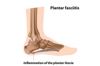 Your Heel Pain May Be the Result of Plantar Fasciitis